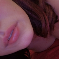 vitiligo95 Nue
